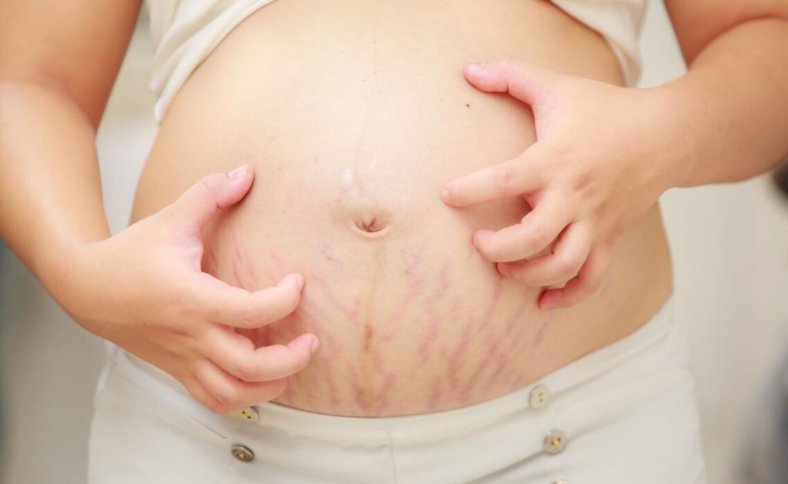 Stretch Marks: What Are They and How Can You Treat Them?